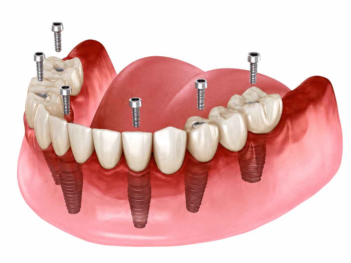 All-on-4 Dental Implants