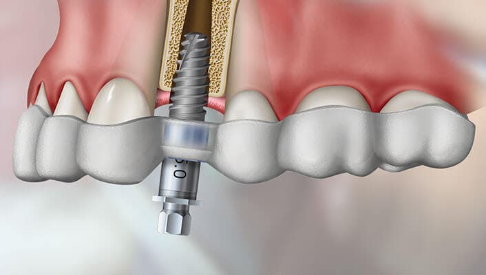 Computer-Guided Implant Surgery