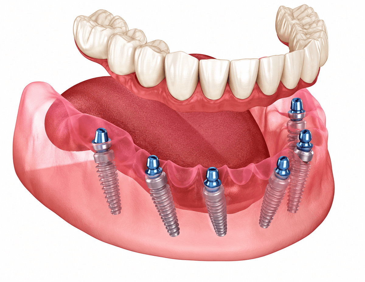 Full Mouth Dental Implants