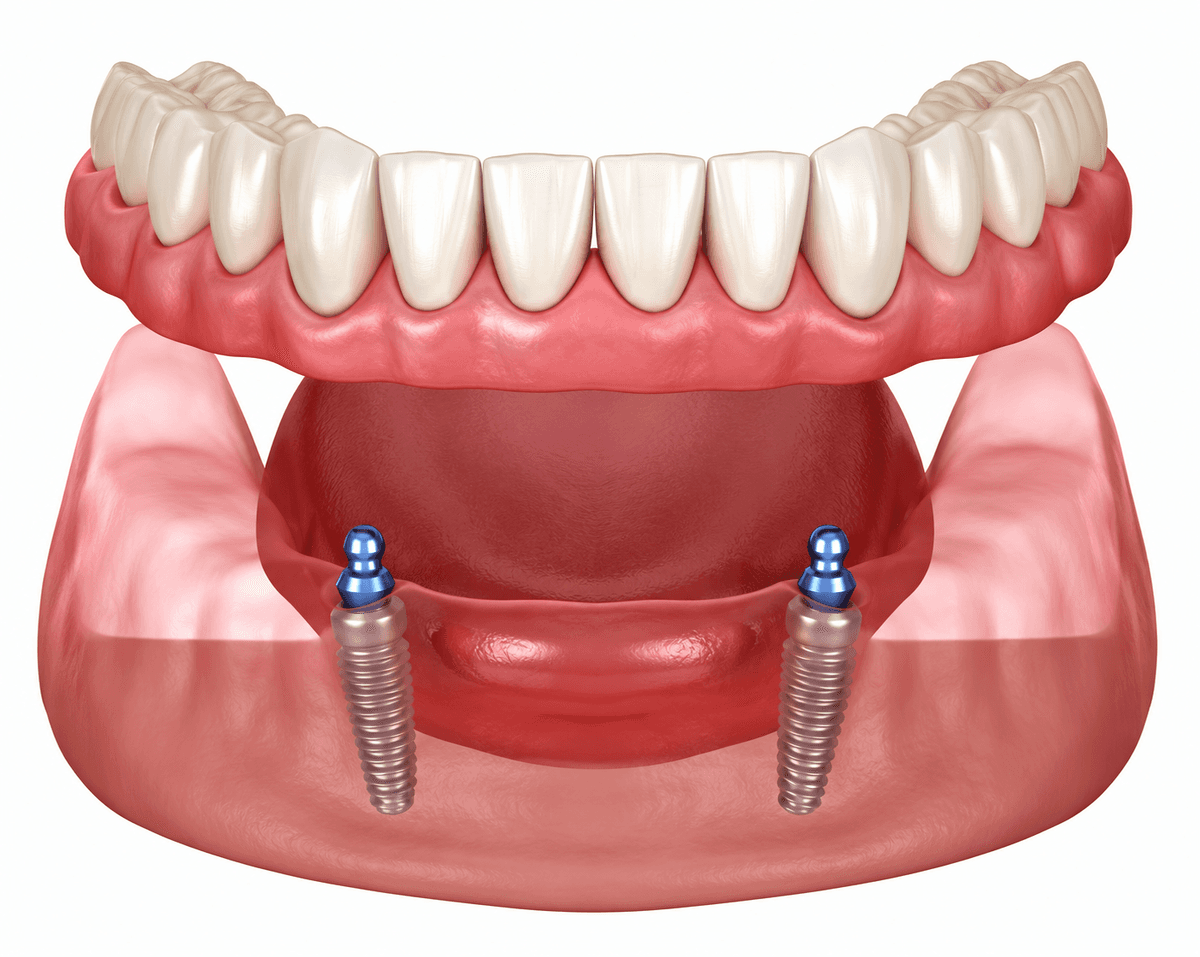 Implant-Supported Dentures