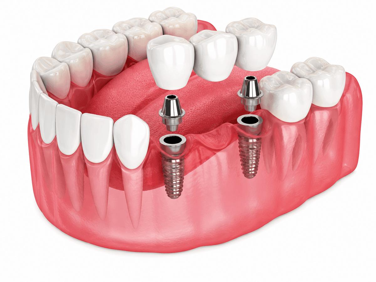 Multiple Teeth Implants